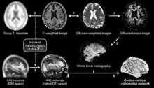 fMRI研究脑功能网络