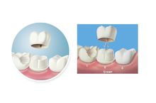 美容冠示意图 美容冠示意图