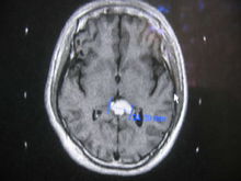 头部松果体 头部松果体