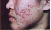 寻常性痤疮